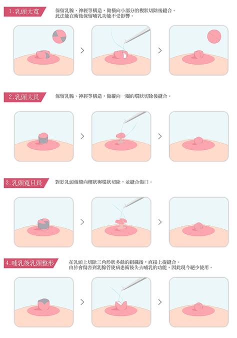 女生奶頭有毛|乳頭內凹、長毛正常嗎？ 8類「乳頭形狀」你的是哪種 